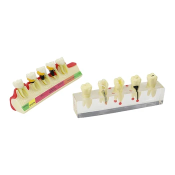 Dentes Devido A Doença Periodontal Modelo De Material Dentário Modelo Dente O Dentista De Comunicação